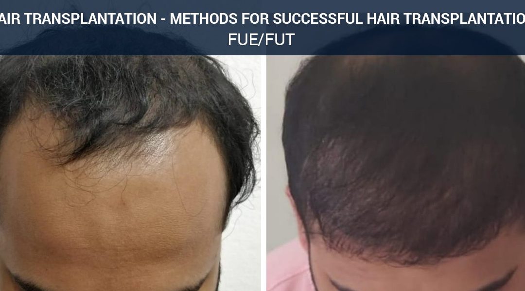 Hair Transplant before and after by the best dermatologist in Ujjain