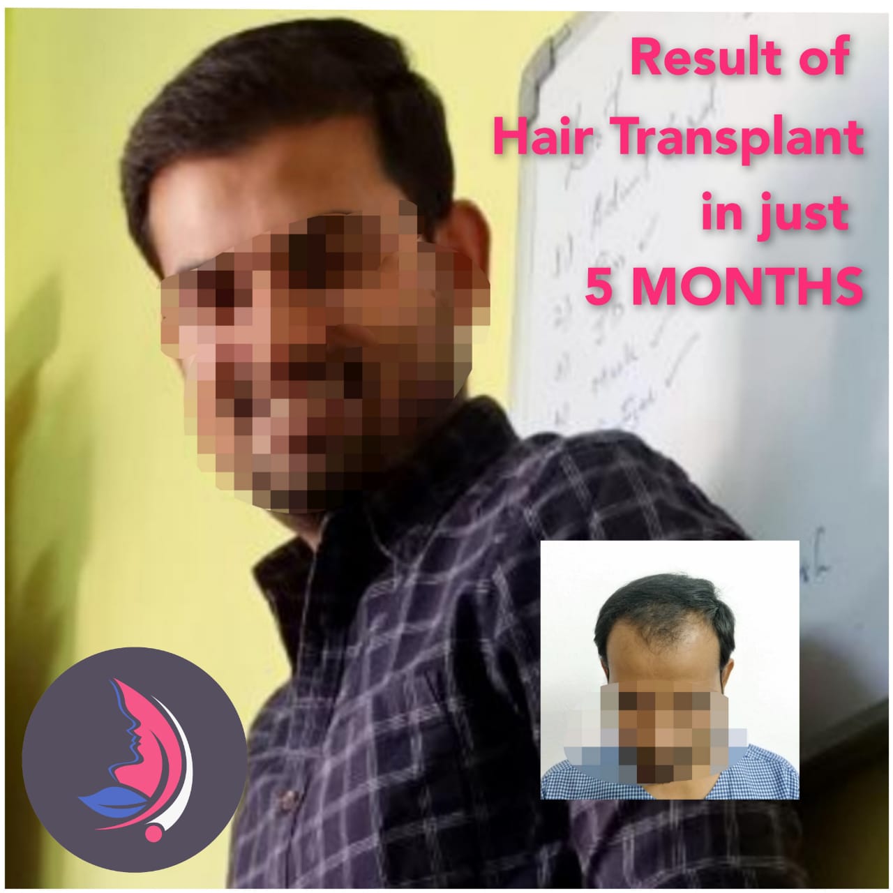 Hair Transplant results gallery