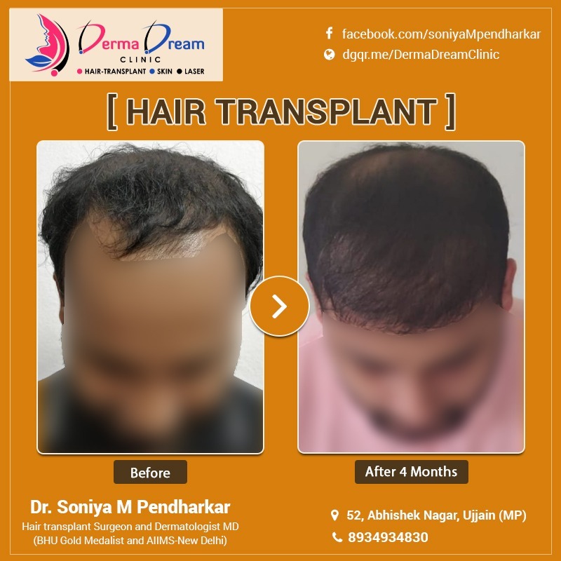 Hair Transplant - before and after