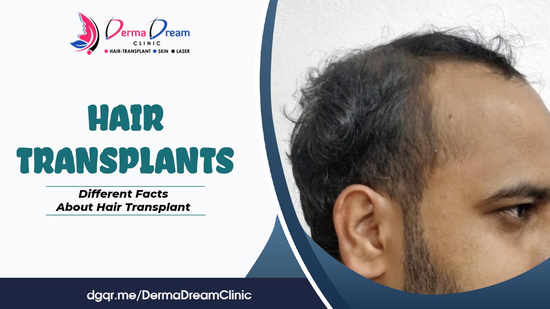 Different facts about Hair Transplant one should know before going for it