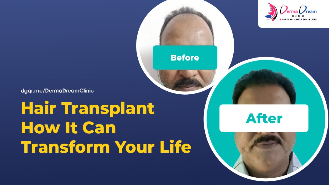 Hair Transplant - Before and After