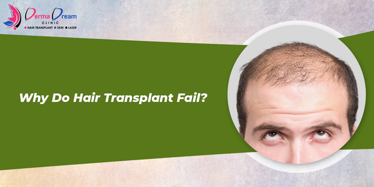 Why Hair Transplant Fail