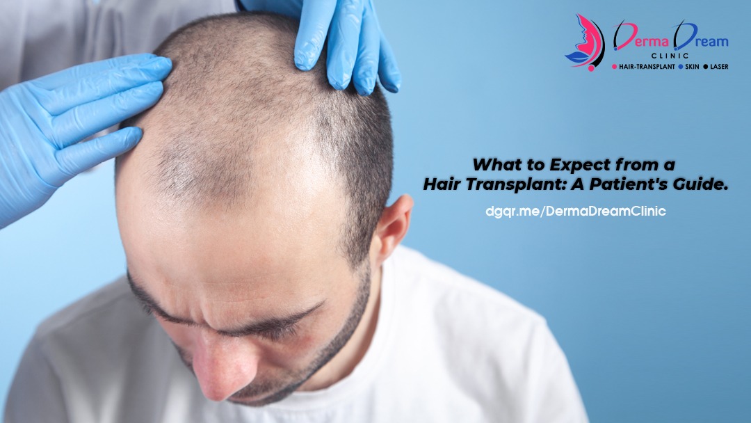 Hair Transplant Guide: What to Expect