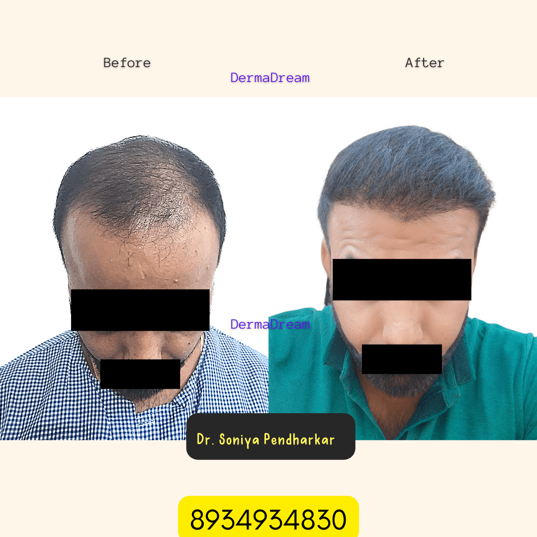 Best Hair Transplant Treatment in Ujjain at affordable prices