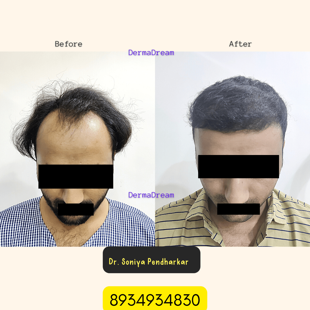 Best Hair Transplant Treatment in Ujjain at affordable prices
